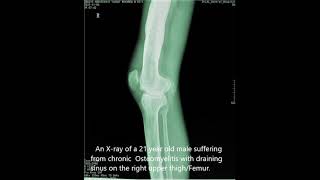 Chronic Osteomyelitis radiology [upl. by Draned]