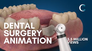 Dental Surgery Animation  Bone Grafting [upl. by Ary]