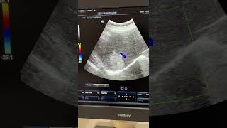 Hepatic Mets  Hemangioma ultrasound sonography hemangioma liver mets hepatic [upl. by Oflodor138]