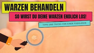 WARZEN BEHANDELN  So wirst du WARZEN endlich los [upl. by Eiramyma561]