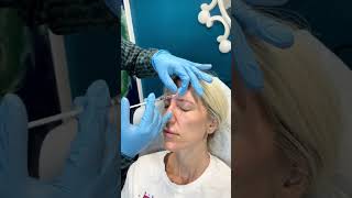 Xeomin Injections At Palm Beach  Xeomin Smart Toxin Injection shorts youtubeshort xeomin [upl. by Campagna]