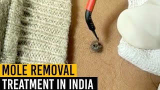 Mole Removal Treatment in India  RF Cautery Treatment  Je Amour India [upl. by Ninetta]