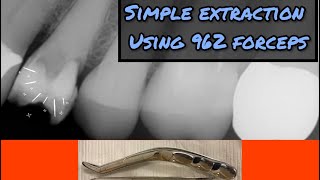 Simple Premolar Extraction with My 962 Forceps [upl. by Irmine]