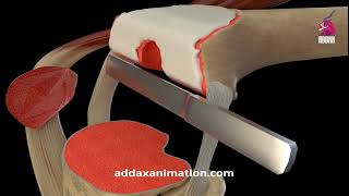 Knee Replacement Surgery 3D animation [upl. by Ambert]