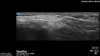 Lateral femoral cutaneous nerve block by Dr Murli Krishna Consultant Pain medicine Bristol [upl. by Feldman]