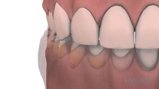 Gingivoplastie et gingivectomie  Centres dentaires Lapointe [upl. by Ennyl509]