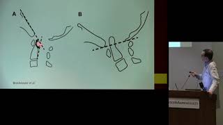 quotChiari Malformations and Chiari 15quot  Robert Kellogg MD [upl. by Hplodnar]