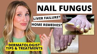 Dermatologist Shares Treatments for Nail Fungus amp Prevention Tips  Dr Sam Ellis [upl. by Panchito51]