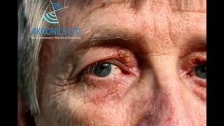 Xanthelasma Removal without TCA [upl. by Waxman113]