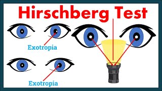 Hirschberg Corneal Reflex Test  A complete Tutorial [upl. by Calesta]