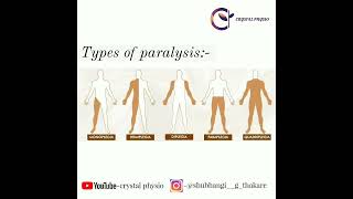 paralysis hemiplegia quadriplegia monoplegia diplegia neurophysiotherapy crystalphysio [upl. by Azmah614]