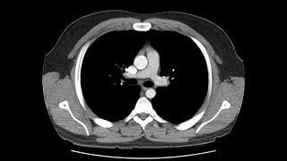 Anatomy of CT scans Thoracic cavity [upl. by Barina]