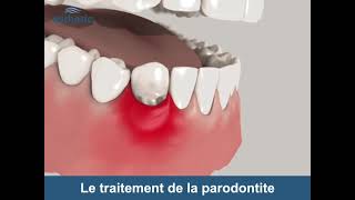 Le traitement de la Parodontite  Esthetic Hair Smile [upl. by Reena]