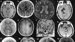 BRAIN NCC NEURO CYSTIC CERCOSIS [upl. by Scurlock792]