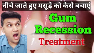 Gum Recession Treatment  Receding Gums  नीचे जाते हुए मसूड़े को कैसे बचाएं [upl. by Duvall]