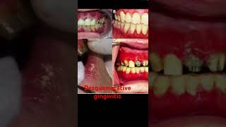 Desquamatative gingivitis [upl. by Nata579]