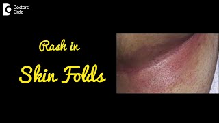 INTERTRIGO  Rash in Skin Folds  Causes Symptoms and Treatment  DrNischal K C  Doctors Circle [upl. by Nauqahs981]