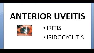 Ophthalmology 162 Anterior Uveitis Iritis IridoCyclitis Non suppurative glaucoma mechanism treatment [upl. by Fischer]