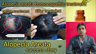 Alopecia areata homoeopathic treatment success story 2 হঠাৎ মাথায় টাক। [upl. by Alys]