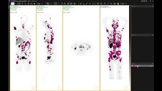 Threshold lesion segmentation in Hermia Multimodality Viewer [upl. by Aeikan692]