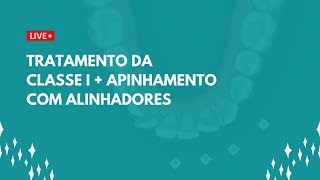 TRATAMENTO DA CLASSE I  APINHAMENTO COM ALINHADORES [upl. by Kissiah110]