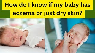 Dry Skin vs Eczema in Babies Natural Remedies [upl. by Ahsinroc604]