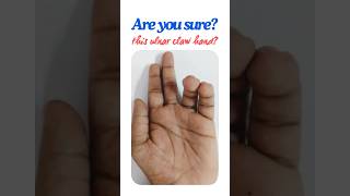 How to be sure of ulnar claw hand Partial claw hand Guyon’s canal syndrome shorts [upl. by Anigal]