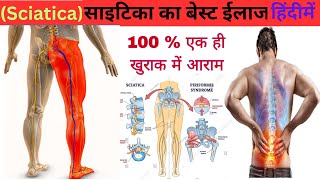 साइटिका का बेस्ट ईलाज  sciatika pain treatment  Leg pain  Hip pain  sciatica best medicine [upl. by Novert]