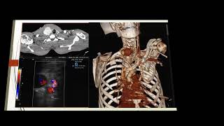 Hepatic artery pseudoaneurysim [upl. by Tioneb]