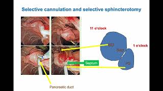 Understanding Pancreatic Duct Anatomy for ERCP Success [upl. by Einal]