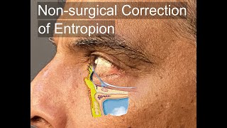 NonSurgical Correction of Involutional Entropion [upl. by Dyer]