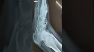 Navicular bone chip fracture viral youtubeshort trending ayurveda [upl. by Kal]