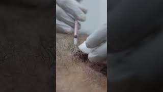 ILS Injection for Keloid Treatment get rid of Keloids with Skinaa Clinic shorts viralskinaclinic [upl. by Anavi]