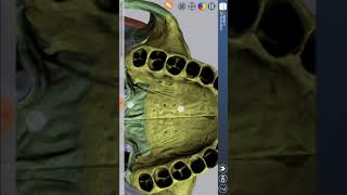 Osteology of Skull Norma Basalis  Anterior part  by Dr Santosh Bhosale [upl. by Aileme]