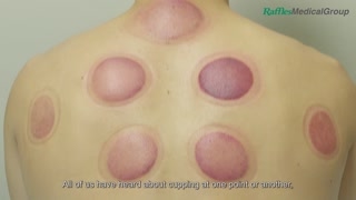 What You Need to Know about Cupping [upl. by Bigot908]