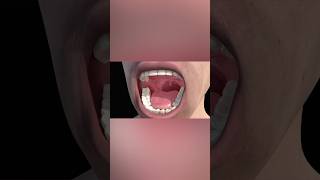 Tonsillitis medicalanimation health [upl. by Pacian]