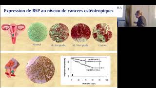 CANCER et Métastases osseuses par Vincent Castronovo [upl. by Naivatco]