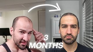 Hair Transplant Results  Now Hair Time  Update [upl. by Azzil451]