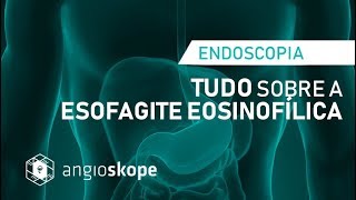 ESOFAGITE EOSINOFÍLICA  Saiba TUDO   Dra Carol Hoff  Clínica Angioskope [upl. by Nilrev]