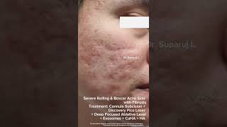 รักษาหลุมสิว Severe Rolling amp Boxcar Acne Scar Cannula Subcision  Discovery Pico Laser CaHA [upl. by Noremak209]