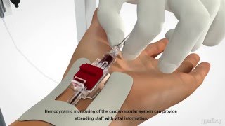 MEDBAR  Arterial Cannula [upl. by Ardy]