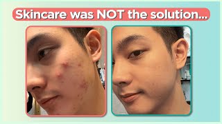 Confused sa pag treat ng ACNE Start here Beginners Guide  Jan Angelo [upl. by Thalia]