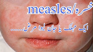 Measles  causes symptoms diagnosis treatmenthealthology by Dr junaid [upl. by Kristofer]