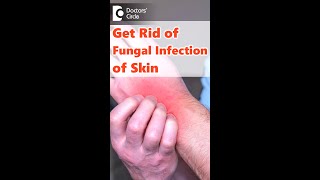 Fungal Infection of Skin Causes Symptoms and Treatment  Dr Amee Daxini  Doctors Circle shorts [upl. by Enylecoj557]