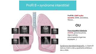 3 Pneumopathies syndromes interstitiels et pleurésie [upl. by Narih]