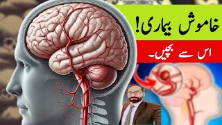 Aneurysm A Silent Killer  Dr Zeeshan [upl. by Fries]