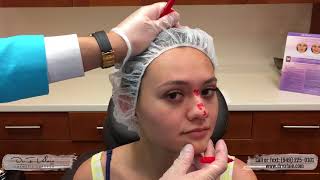 Nose Job without Surgery on Camera  Dr Valaie MD [upl. by Tirzah]