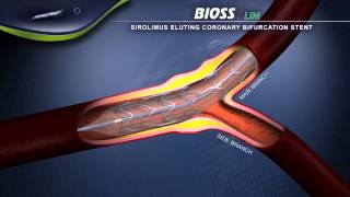 Przepychanie żył Stent BIOSS LIM [upl. by Intyrb867]