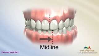 Orthodontic Treatment for Narrow Upper Jaw with Functional Shift  Expander or Spacer [upl. by Gnoud836]