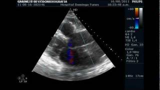 VEGETACION VALVULAR AORTICA en varon de 71 a Dr Pedro Guillermo Bustos 19 Agosto 2011wmv [upl. by Misab]